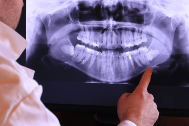 Best Knocked-Out Tooth (Avulsed Tooth) Treatment in Brookfield, WI